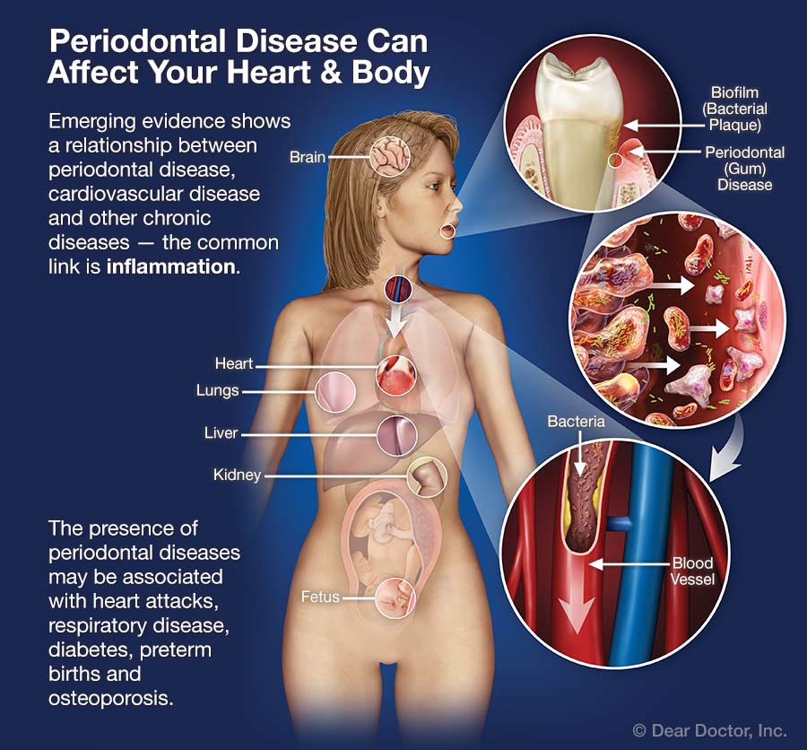 Periodontal Disease Can Affect Your Heart and Body.